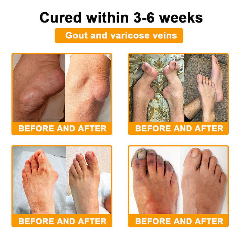𝒖𝒌 𝑯𝒆𝒂𝒍𝒕𝒉 𝑶𝒏𝒍𝒊𝒏𝒆 | Purelora®🔥 BEE VENOM LITHOSPERMUM Pain-Relief Bone Healing Cream 👑👑(Specially for older adults)