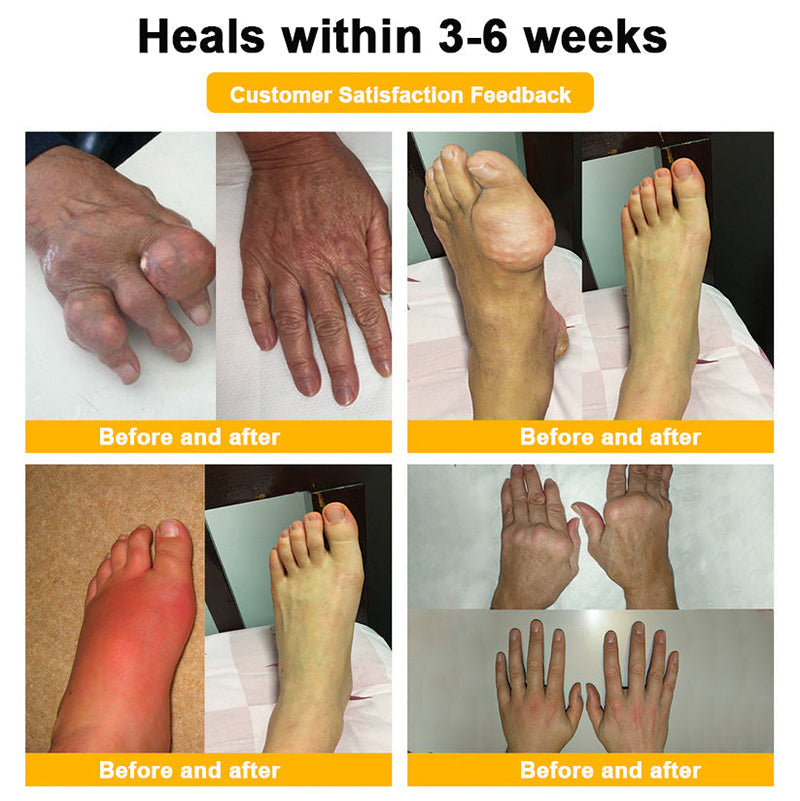 𝒖𝒌 𝑯𝒆𝒂𝒍𝒕𝒉 𝑶𝒏𝒍𝒊𝒏𝒆 | Purelora®🔥 BEE VENOM LITHOSPERMUM Pain-Relief Bone Healing Cream 👑👑(Specially for older adults)