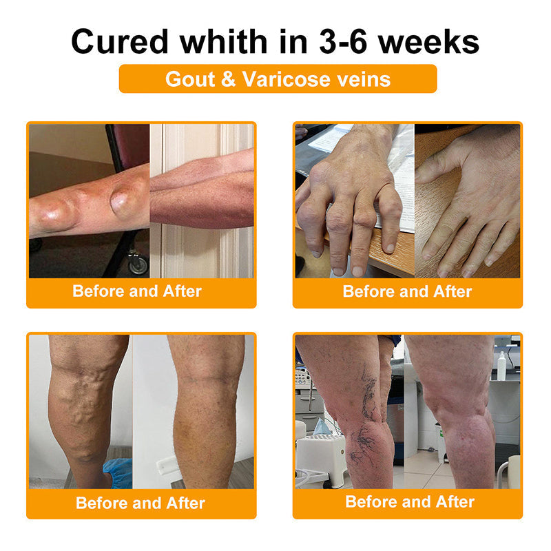 𝒖𝒌 𝑯𝒆𝒂𝒍𝒕𝒉 𝑶𝒏𝒍𝒊𝒏𝒆 | Purelora®🔥 BEE VENOM LITHOSPERMUM Pain-Relief Bone Healing Cream 👑👑(Specially for older adults)